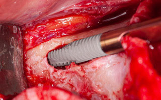 impianti zigomatici corso implantologia iaid